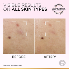 L’Oréal Paris Glycolic-Bright Anti-Dark Spot Exfoliant Peel